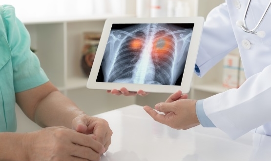 New AI Based Test Can Identify Lung Cancer With 90% Accuracy